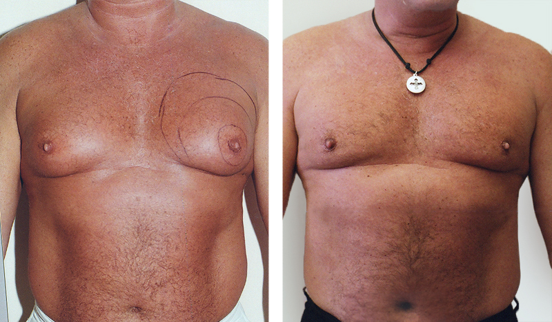 Гинекомастия - фото до и после операции
