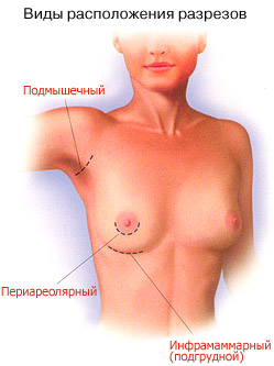 увеличение грудных желез